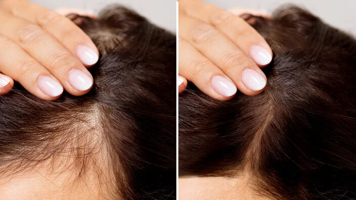 Solutions for Thinning Hair: Treatments that Work